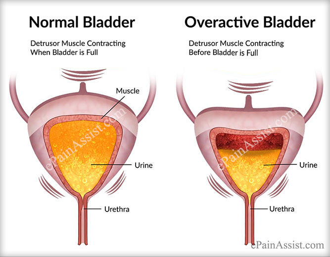 overactive-bladder.jpg