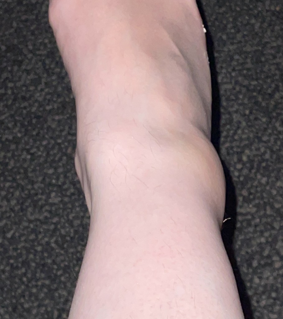Ankle currently June 2024